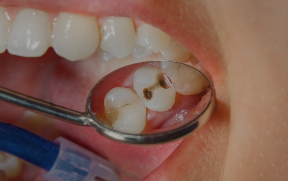 tooth Cavities